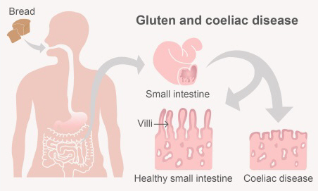 An illustration of the digestive system showing location of small intestine and what damaged villi look like. 