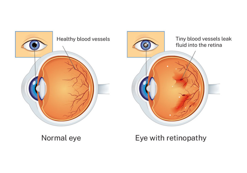 An illustration showing the cross section of a normal eye and another image of an eye with diabetic retinopathy. 