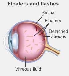 Medical illustration of the eye showing the retina, floaters, detached vitreous, and vitreous fluid.