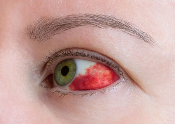 redness in the left side of a women's eye showing subconjunctival haemorrhage
