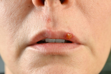 Close up photo of a man's mouth with a single red sore on his lip. 