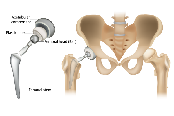 Interior view of a pelvis and hip. Shows where a new hip ball is fitted into a hip socket and fixed into a thigh bone (femur). 