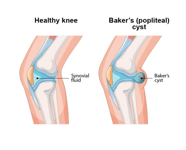 Anatomic illustration of the knee with a Baker's cyst, or popliteal cyst