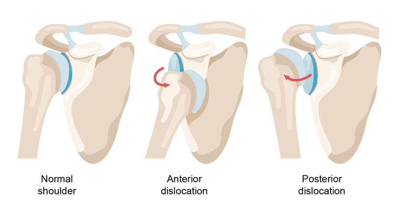 Anatomic illustration of the shoulder joint showing forward (anterior) dislocation and backward (posterior) dislocation.