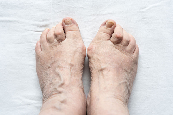 Photograph of feet with hammertoe