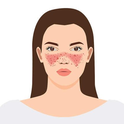 Illustration of a typical butterfly-shaped rash on the face of a person with lupus