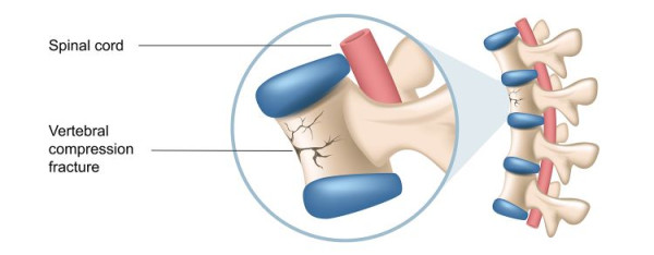 Spinal compression fracture — anatomic illustration