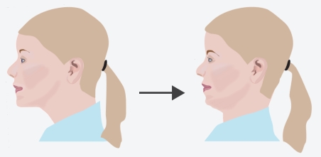 An illustration of how to do the chin tuck exercise for relieving neck pain 